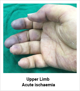 Upper Limb Acute Ischaemia